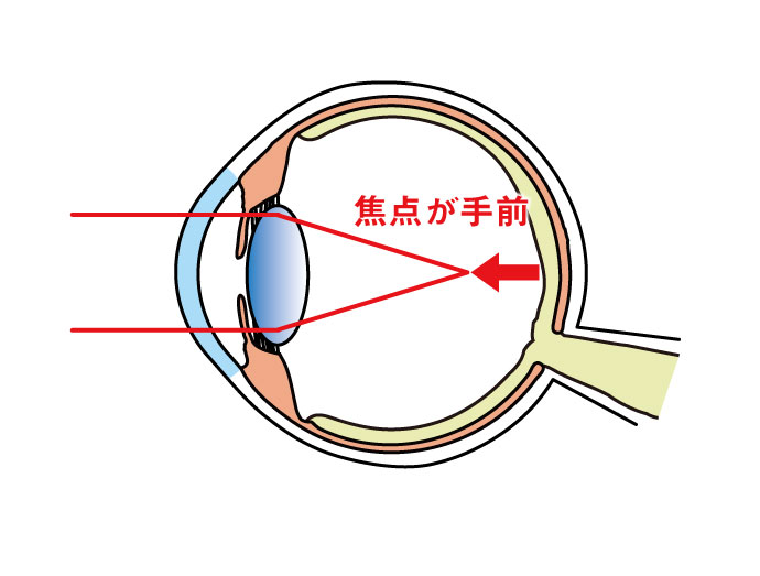 近視