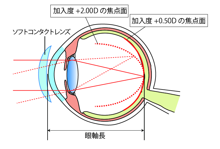 多焦点ソフトコンタクトレンズ使用時の焦点